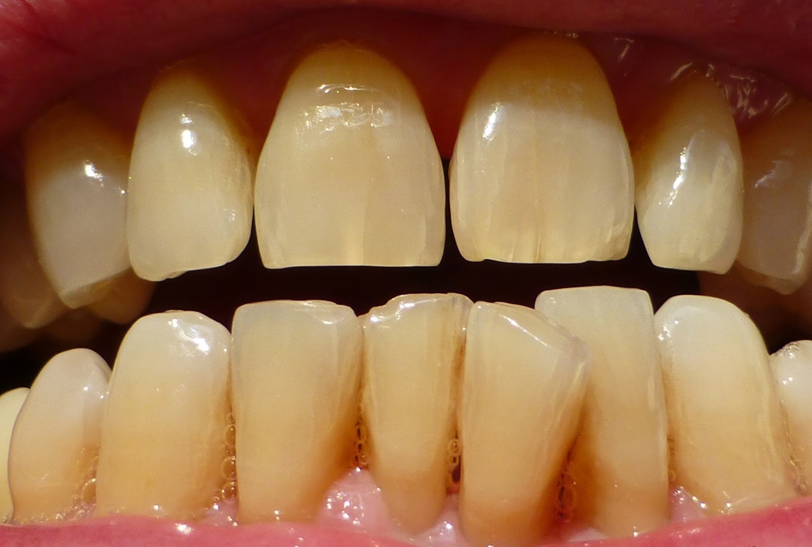 5 cách làm trắng răng từ nguyên liệu tự nhiên